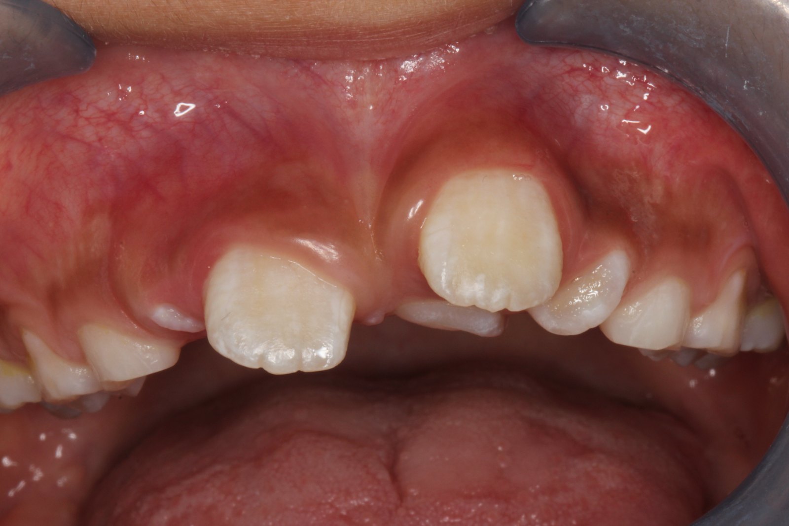 多生牙的小知识