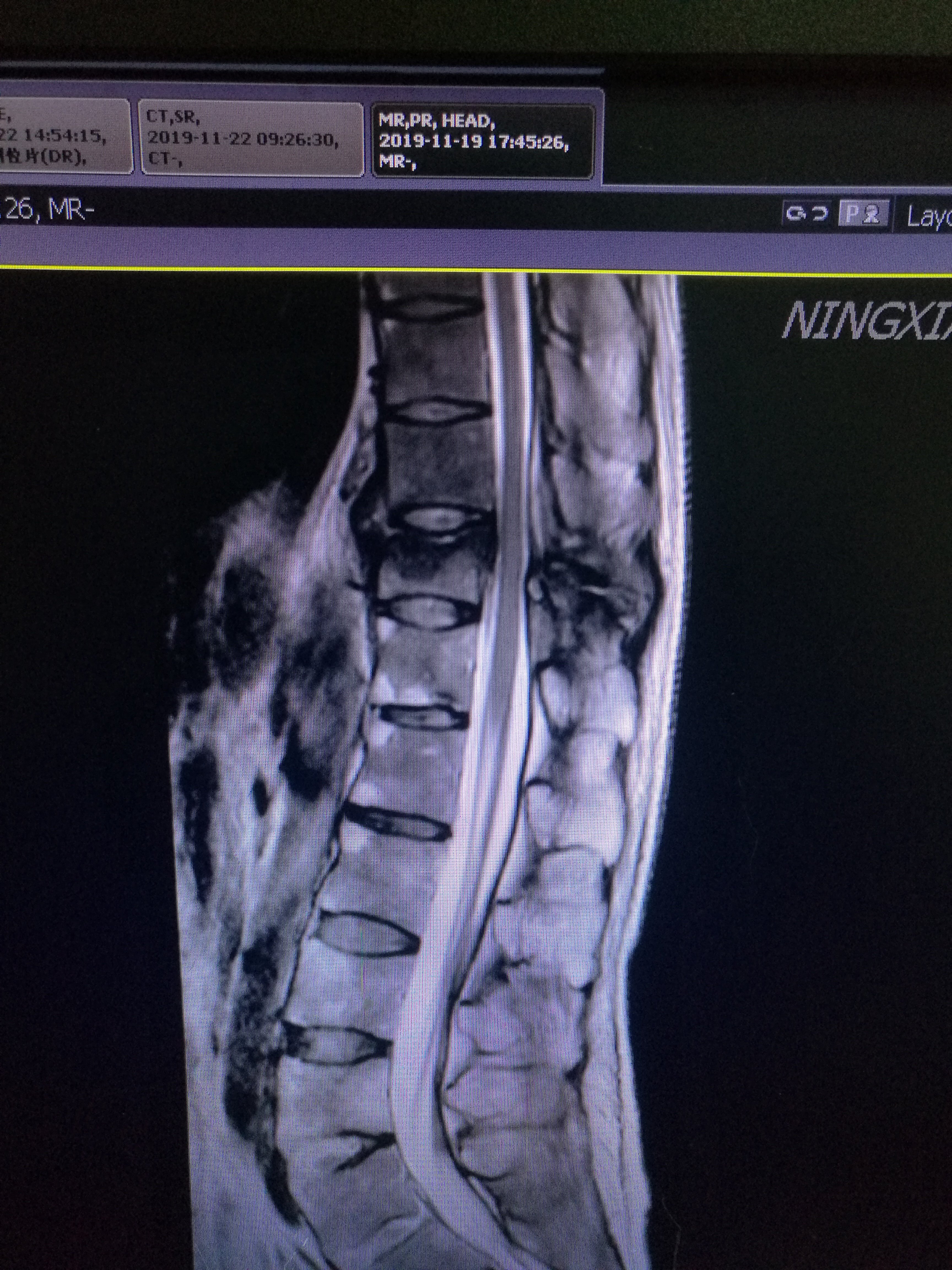 强直性脊柱炎x线表现图片