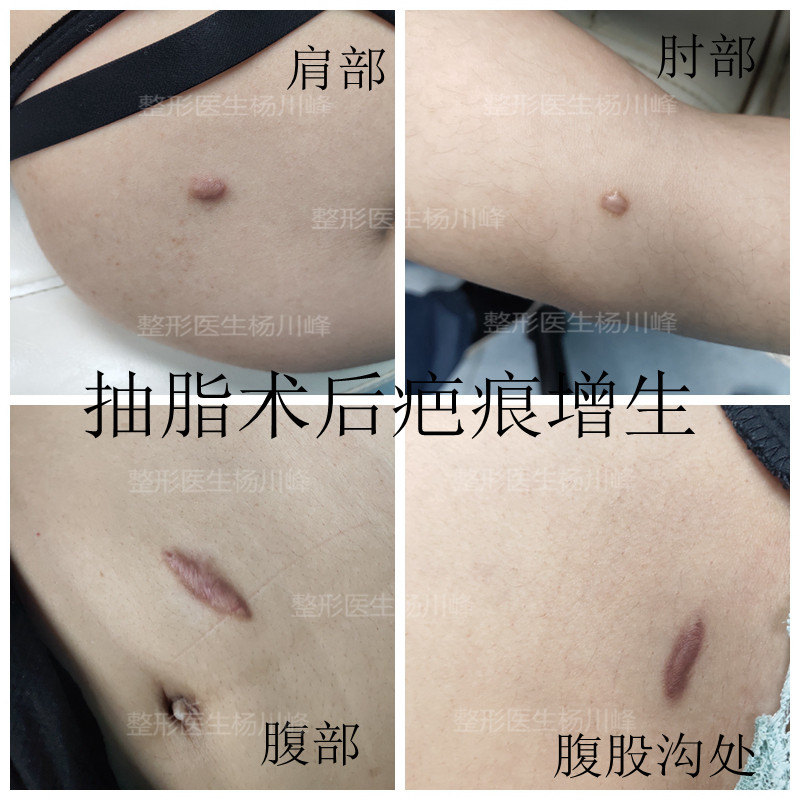吸脂术后长了疤怎么办 吸脂