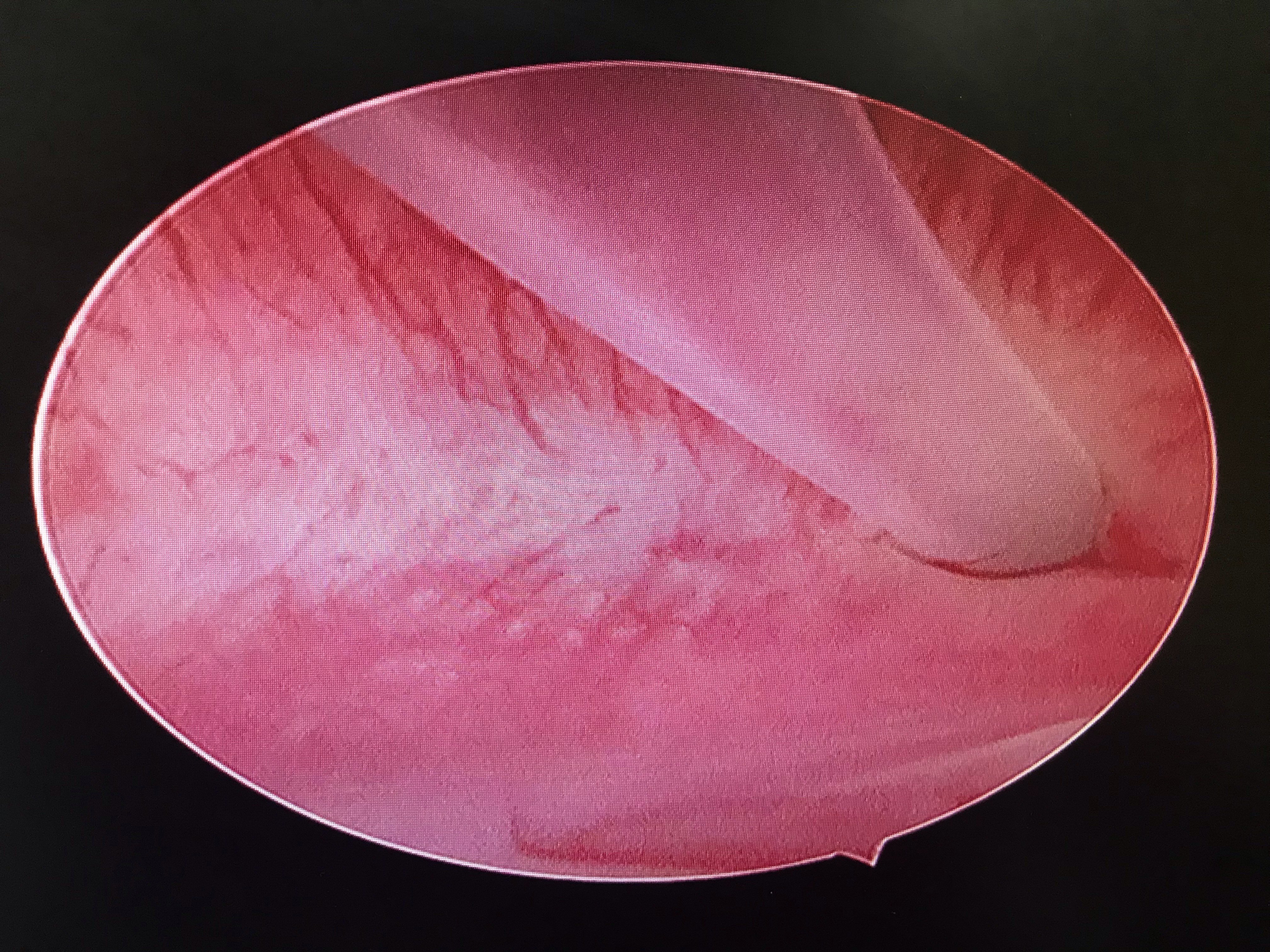 用输卵管通液管插在开口的位置,助手推注液体感受阻力的大小,同时观察