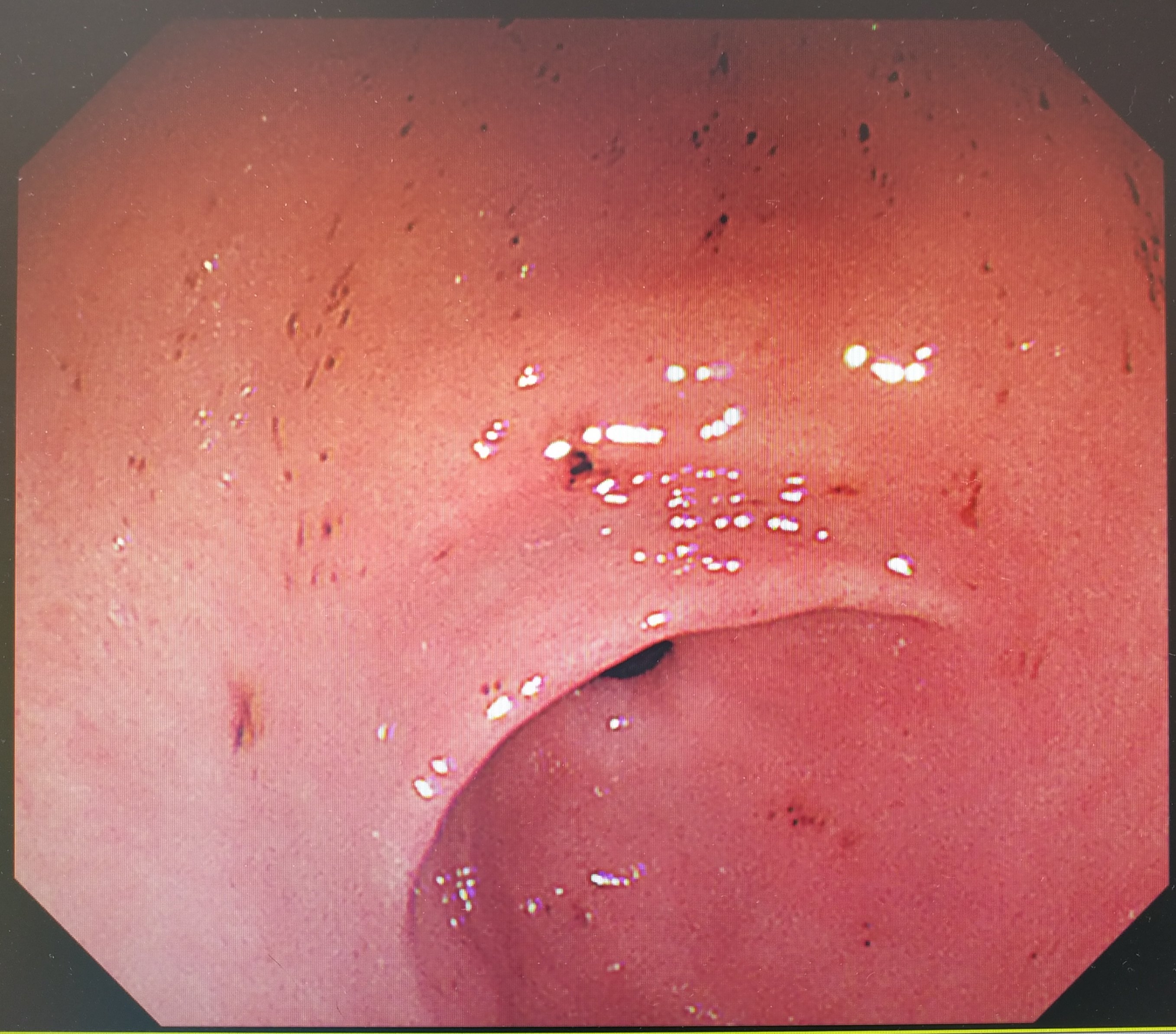 慢性胃溃疡镜下图片