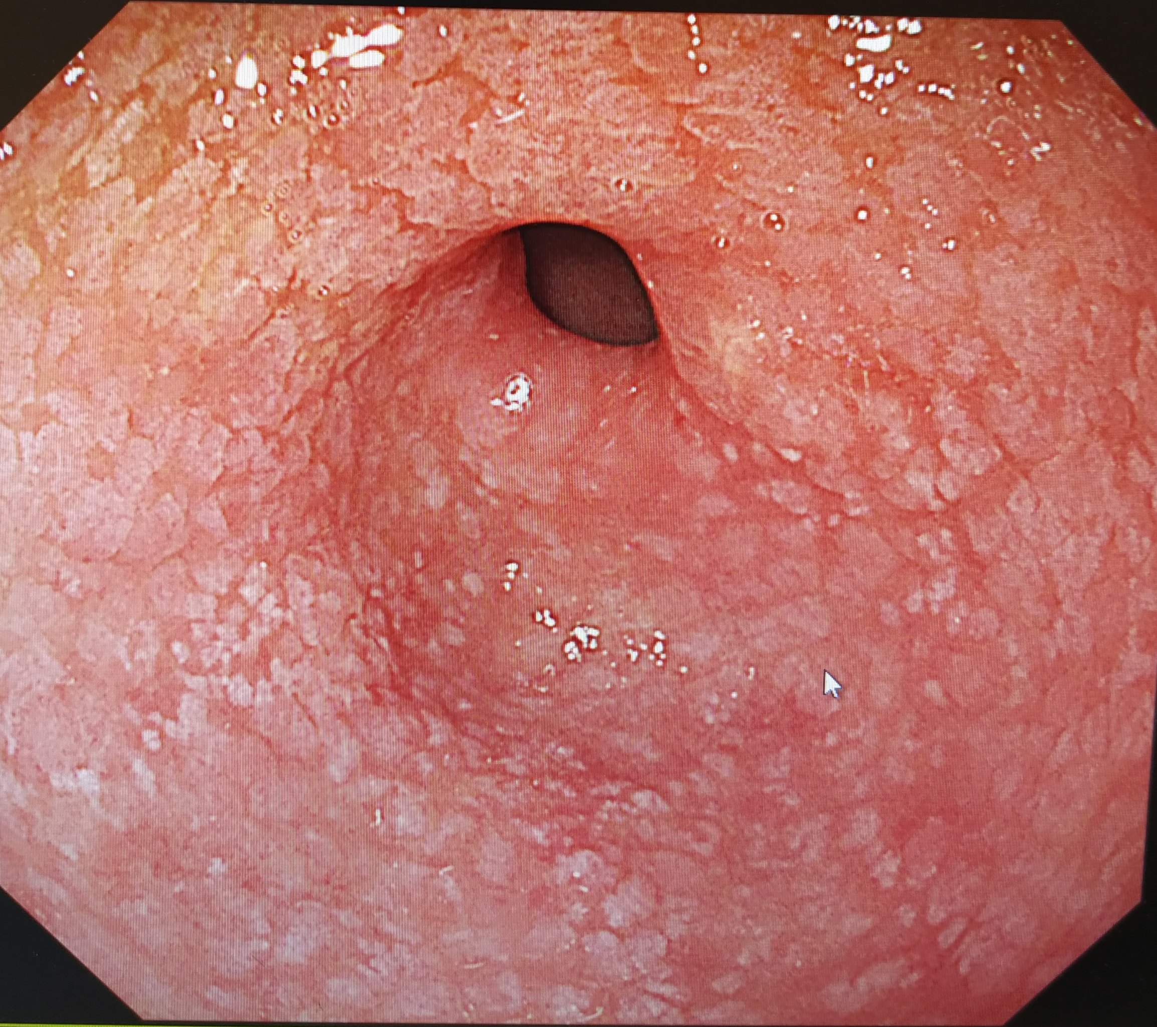 胃窦溃疡图片图片