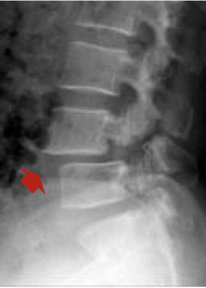 腰椎4一5节滑脱图图片