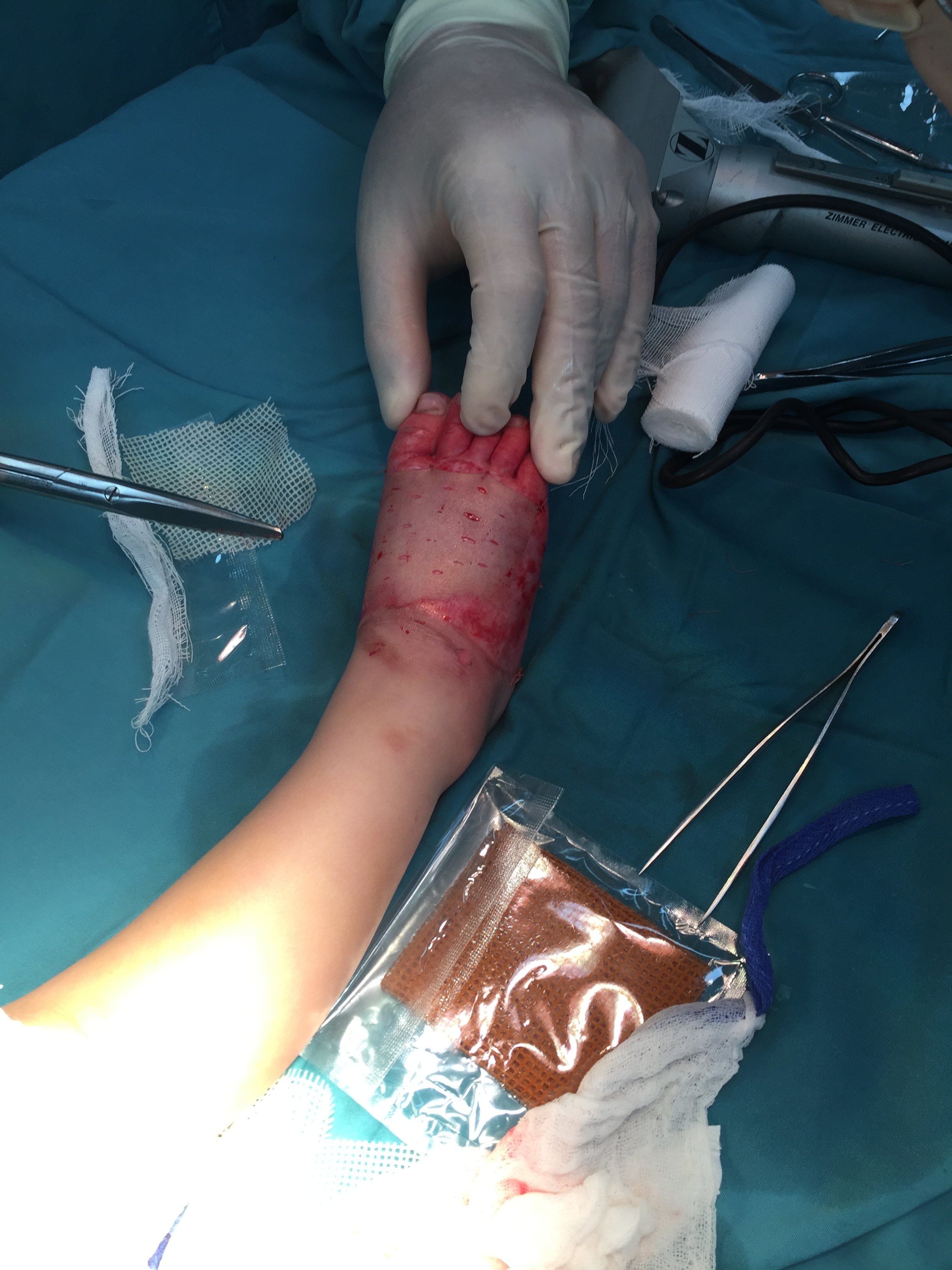 一岁儿童足背深度烧伤大张中厚皮移植效果