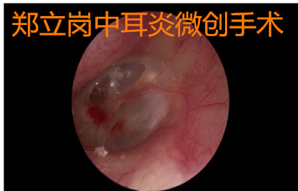 鼓膜小穿孔耳內鏡微創手術巧治癒