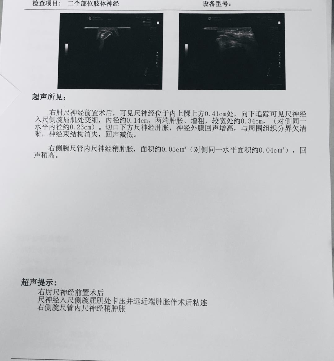 肌骨超声手术前x片手术中资料第一次尺神经前移不够,形成内上髁对尺