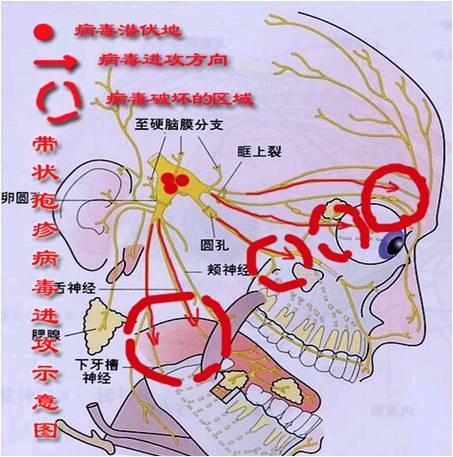 這是病毒侵犯了支配頭面部感覺的三叉神經第一支眼支所致有一種特殊