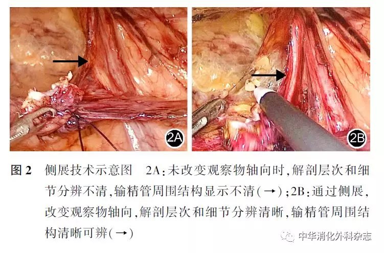 專家論壇經腹腔腹膜前腹股溝疝修補術技巧的探討陳雙江志鵬