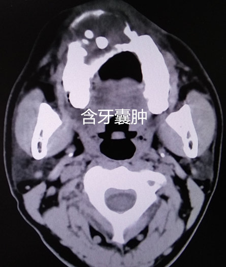 含牙囊肿3_副本.jpg