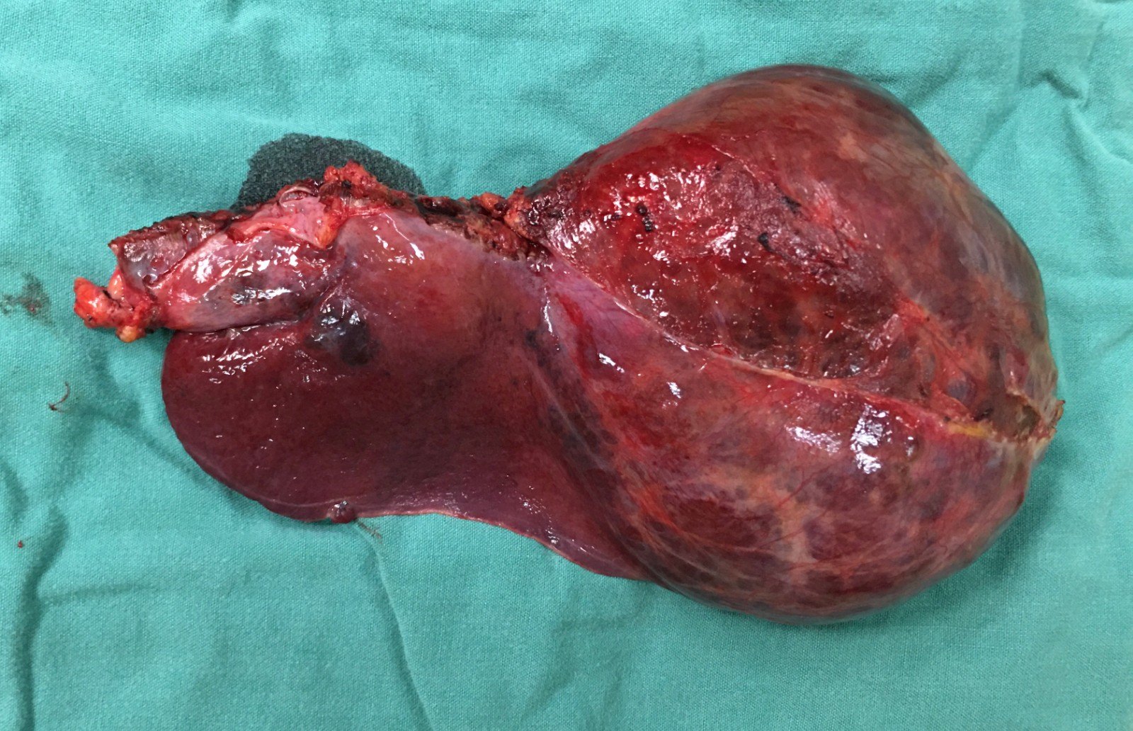 肝巨大血管瘤(10*9厘米)的左半肝切除术