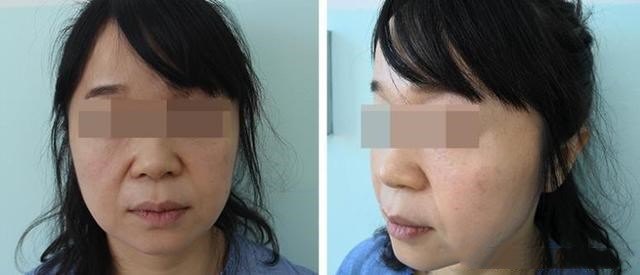 关于面部松弛下垂,必须要了解的知识_皮肤松弛_治疗介绍_缓解方法