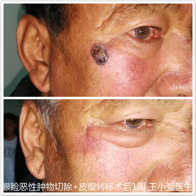 眼睑肿物的手术重点不在于切除肿物本身,而在于切除肿物后如何进行
