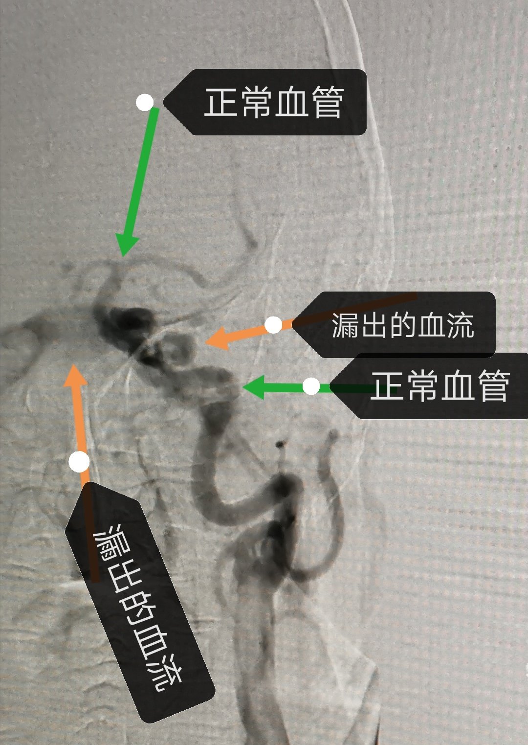 颈动脉海绵窦瘘图片图片