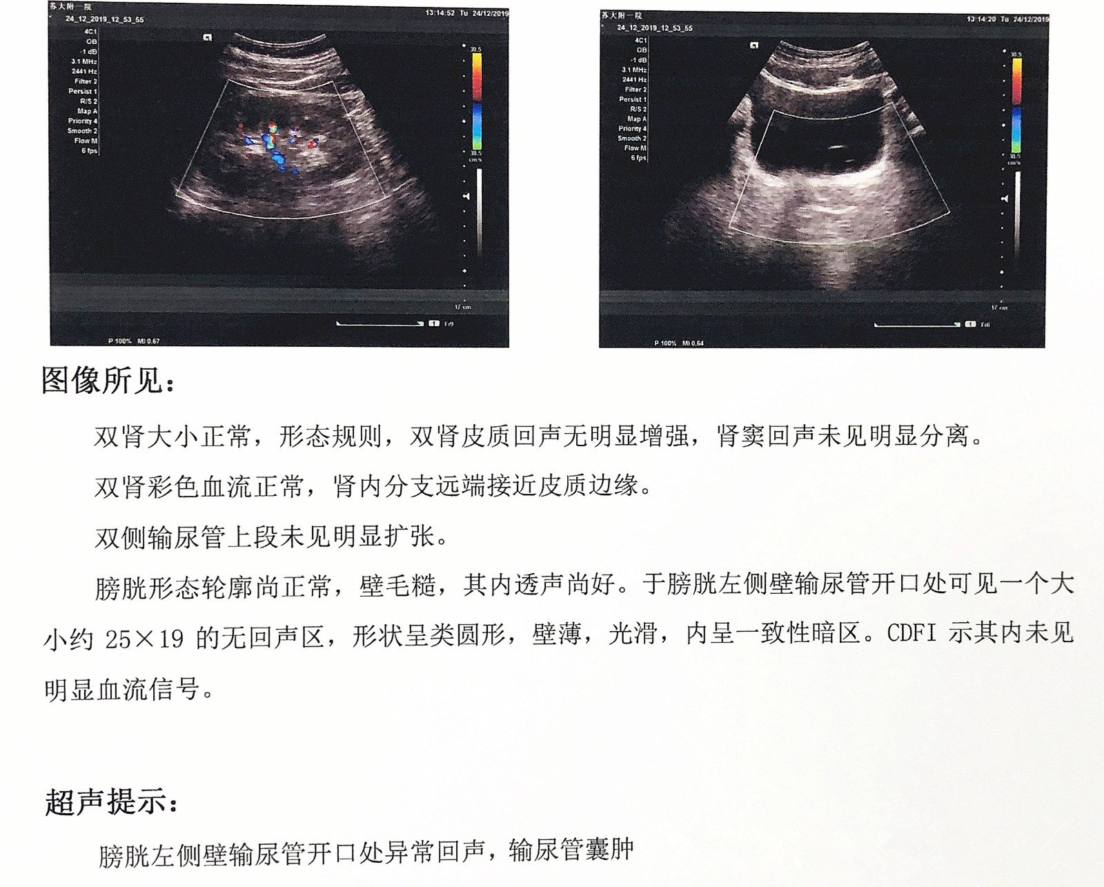 膀胱囊肿超声图片图片