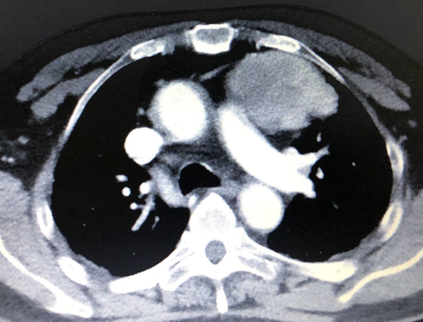 胸腺瘤的良恶性判断和分期 - 好大夫在线