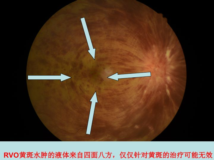 虹膜nv,nvg01視網膜組織缺血誘發新生血管01黃斑水腫,視力損害的