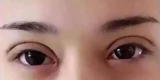 双眼皮割宽了算手术失败吗?_双眼皮手术_风险_治疗介绍 - 好大夫在线