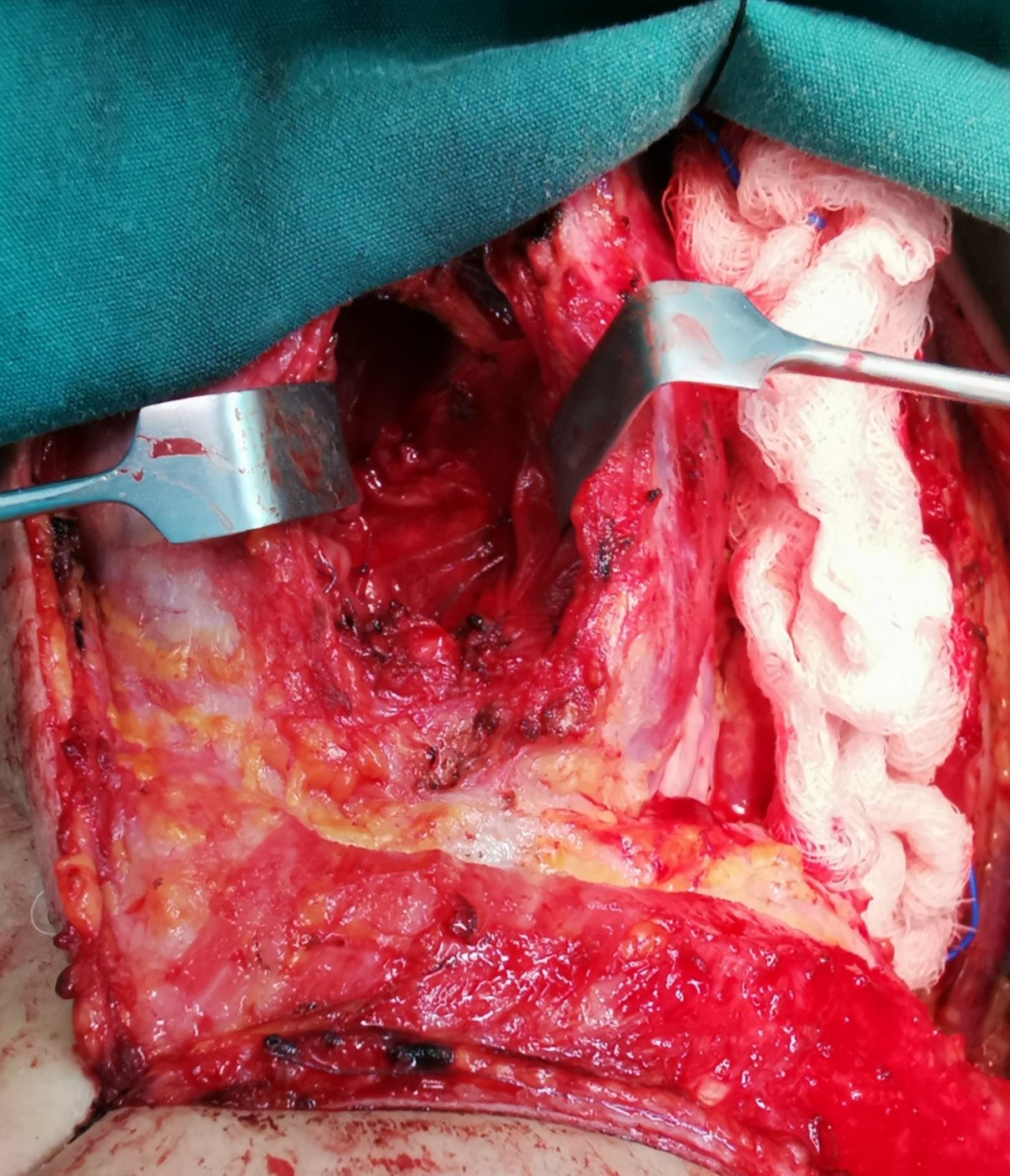 喉咙异物感喉癌_喉癌异物感会时有时无码_喉咙异物感一个月喉癌