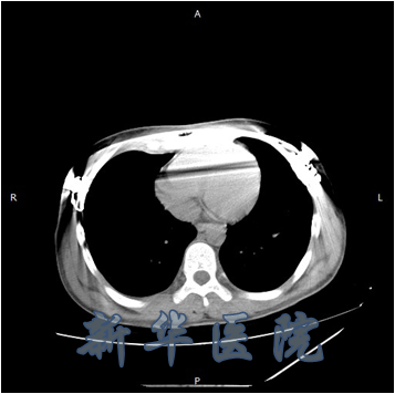 鸡胸x线图片图片