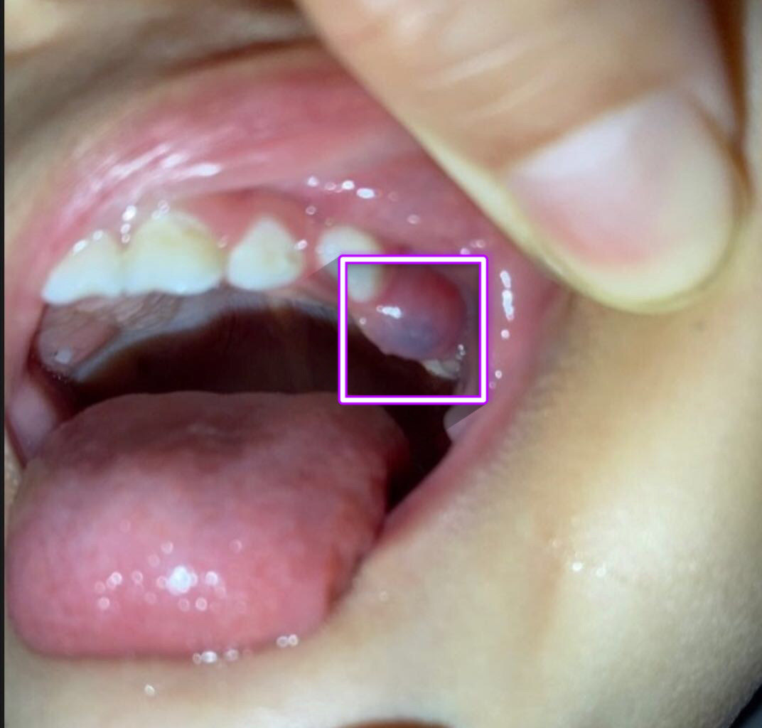 小孩牙龈化脓图片图片