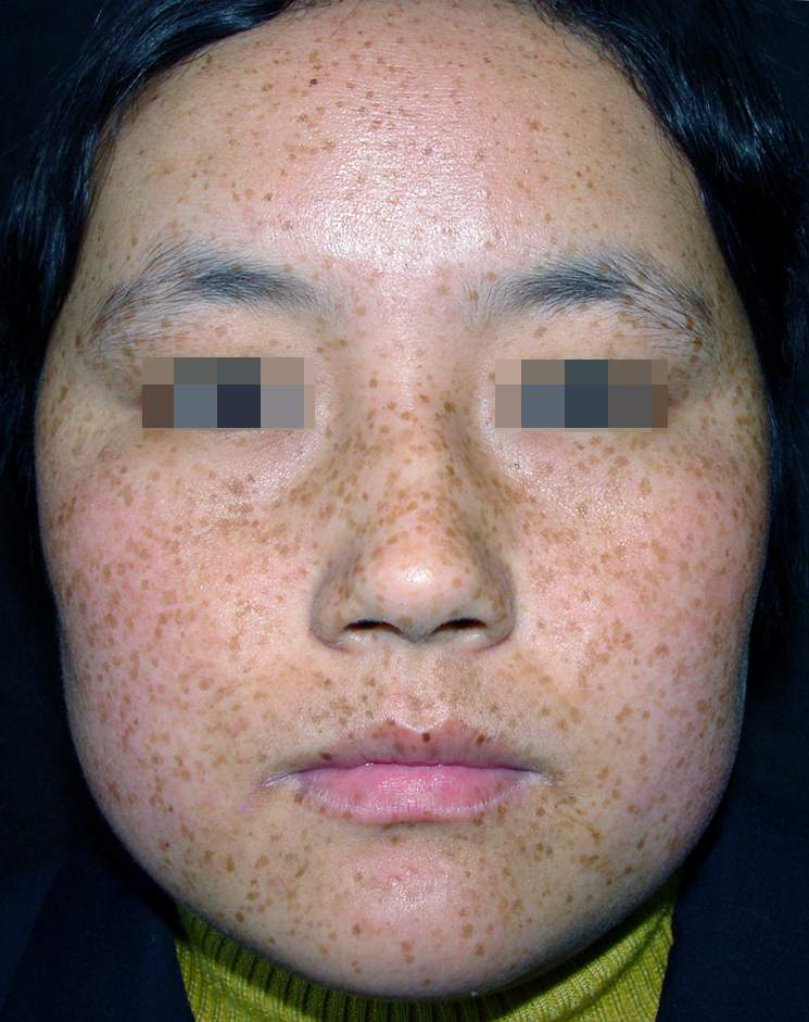 haodf:8:queban--> !--haodf:8:queban-->雀斑 !