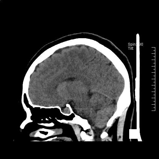 复发性垂体腺瘤合并部分空泡蝶鞍的内镜经蝶手术治疗 