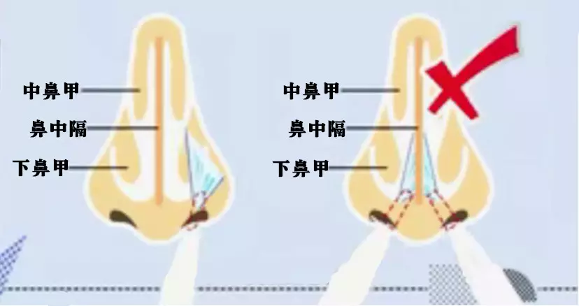 鼻腔喷药你做对了吗