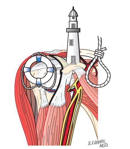 肩关节镜手术前侧入路在哪里?从哪里进入肩关节腔的? - 好大夫在线