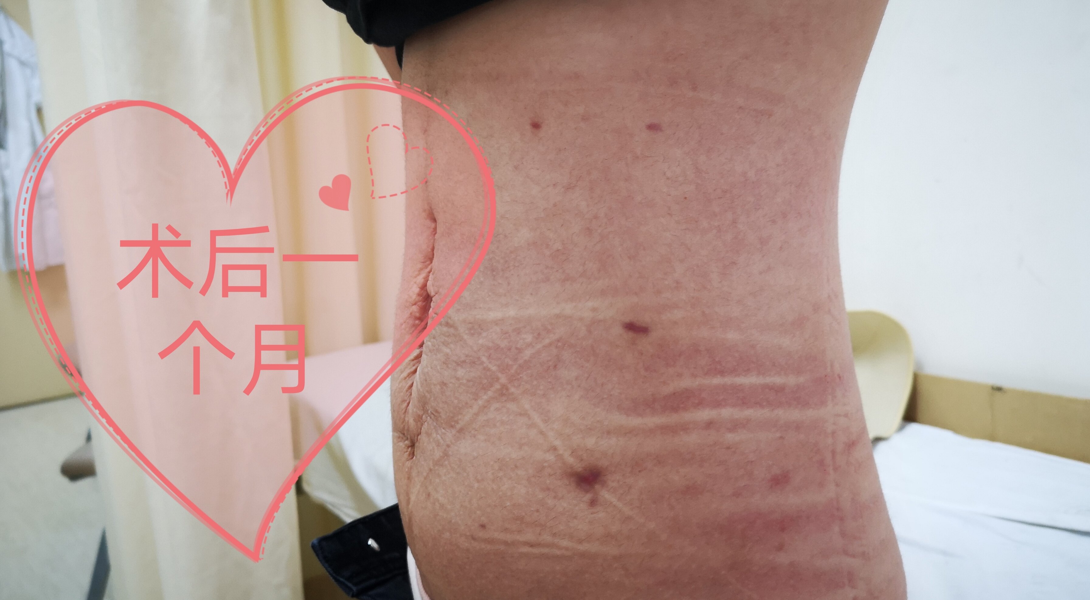 分享一位美丽女孩儿修复产后腹直肌的体验 - 好大夫在线