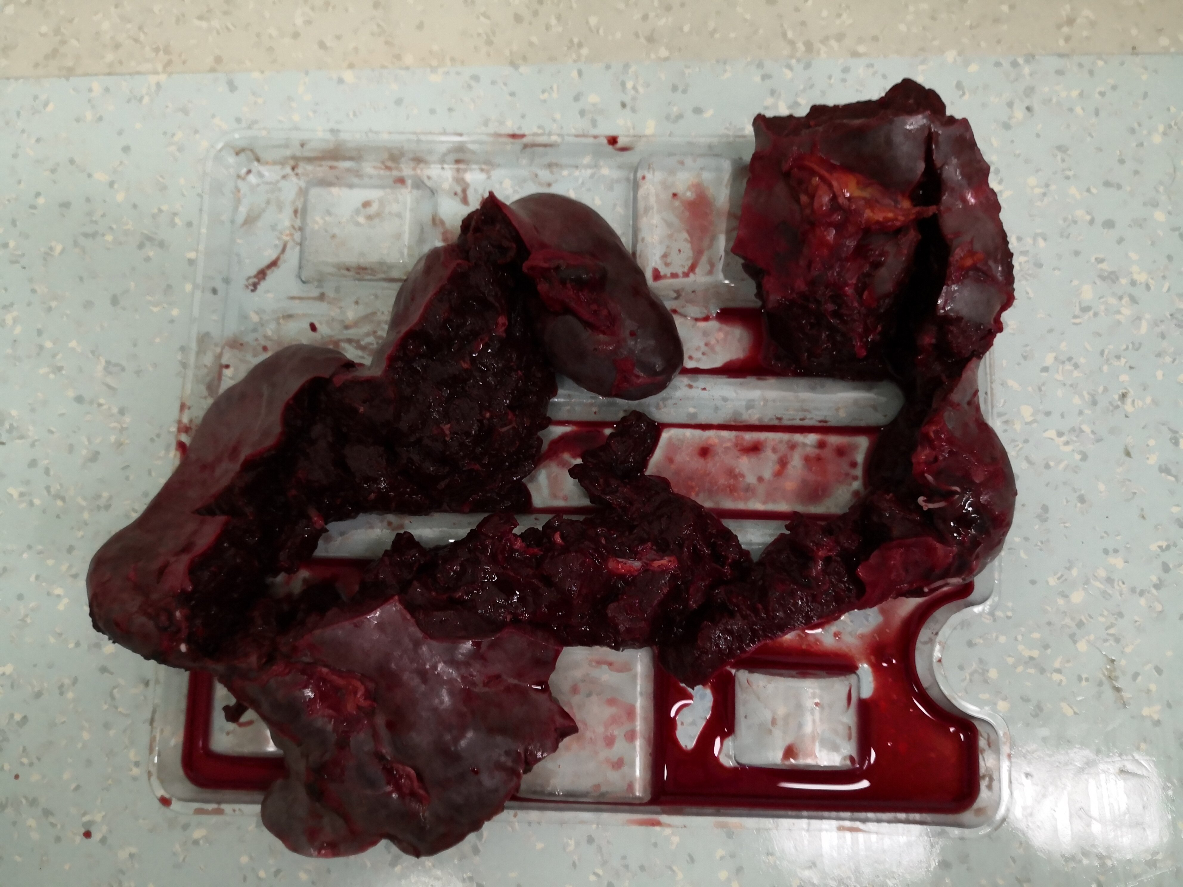 门静脉海绵样变门静脉高压症食管胃底静脉曲张破裂出血的治疗以内镜和