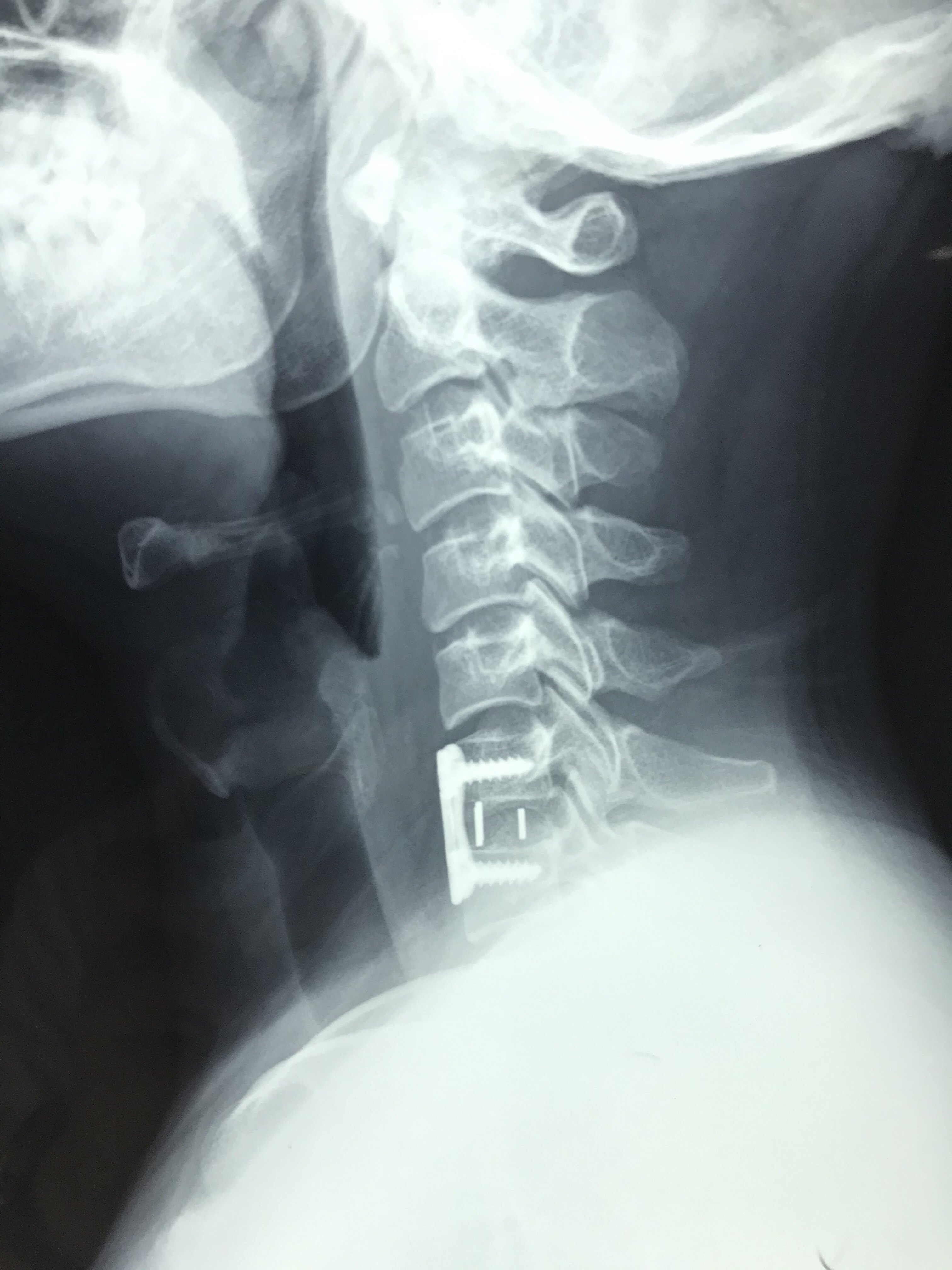 颈椎突出x光片图片