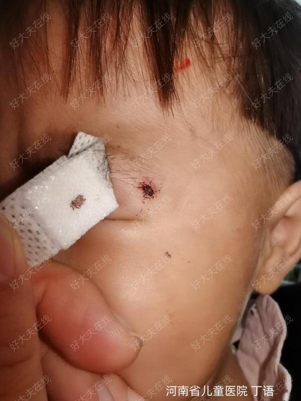 面部肉芽肿血管瘤_血管瘤 - 好大夫在线