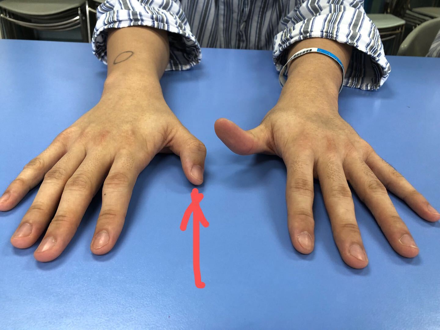 拇长伸肌腱损伤 肌腱移植 好大夫在线 拇长伸肌腱损伤 肌腱移植 好大夫在线