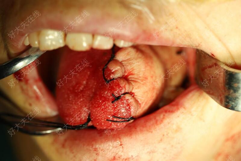 舌鳞癌图片