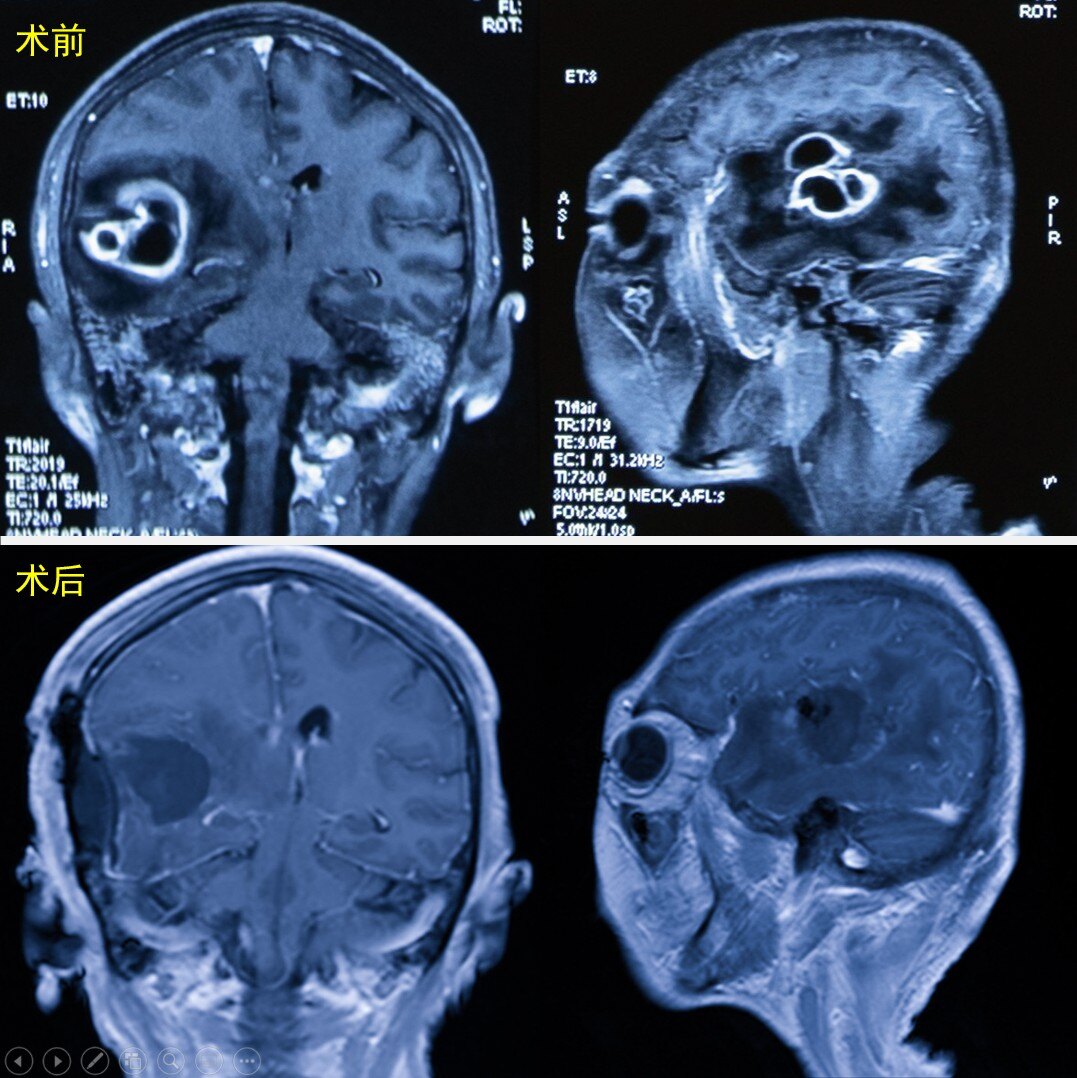 脑脓肿磁共振表现图像图片