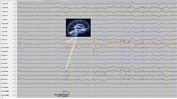 视觉先兆在颞叶,顶叶,枕叶癫痫中都有报道(下图为一位患者发作期脑电