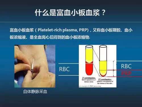 可以获得10ml的prp,离心后的血液只得倒掉