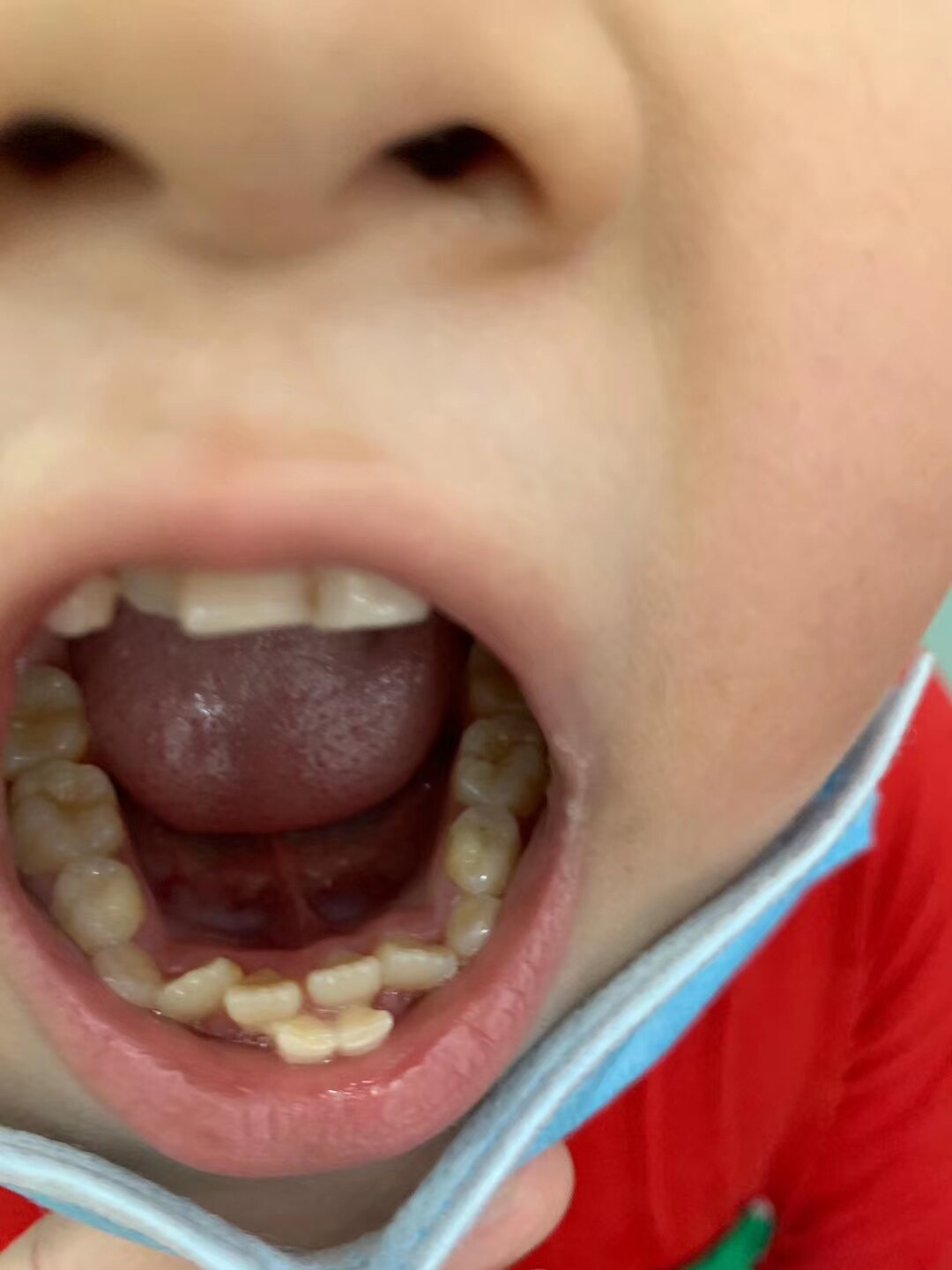 牙齿长在牙龈外面图片图片