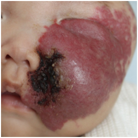 新冠疫情下被耽误治疗的婴幼儿血管瘤_婴幼儿血管瘤_介绍_治疗方式