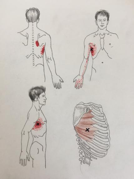 胸背筋膜炎图片