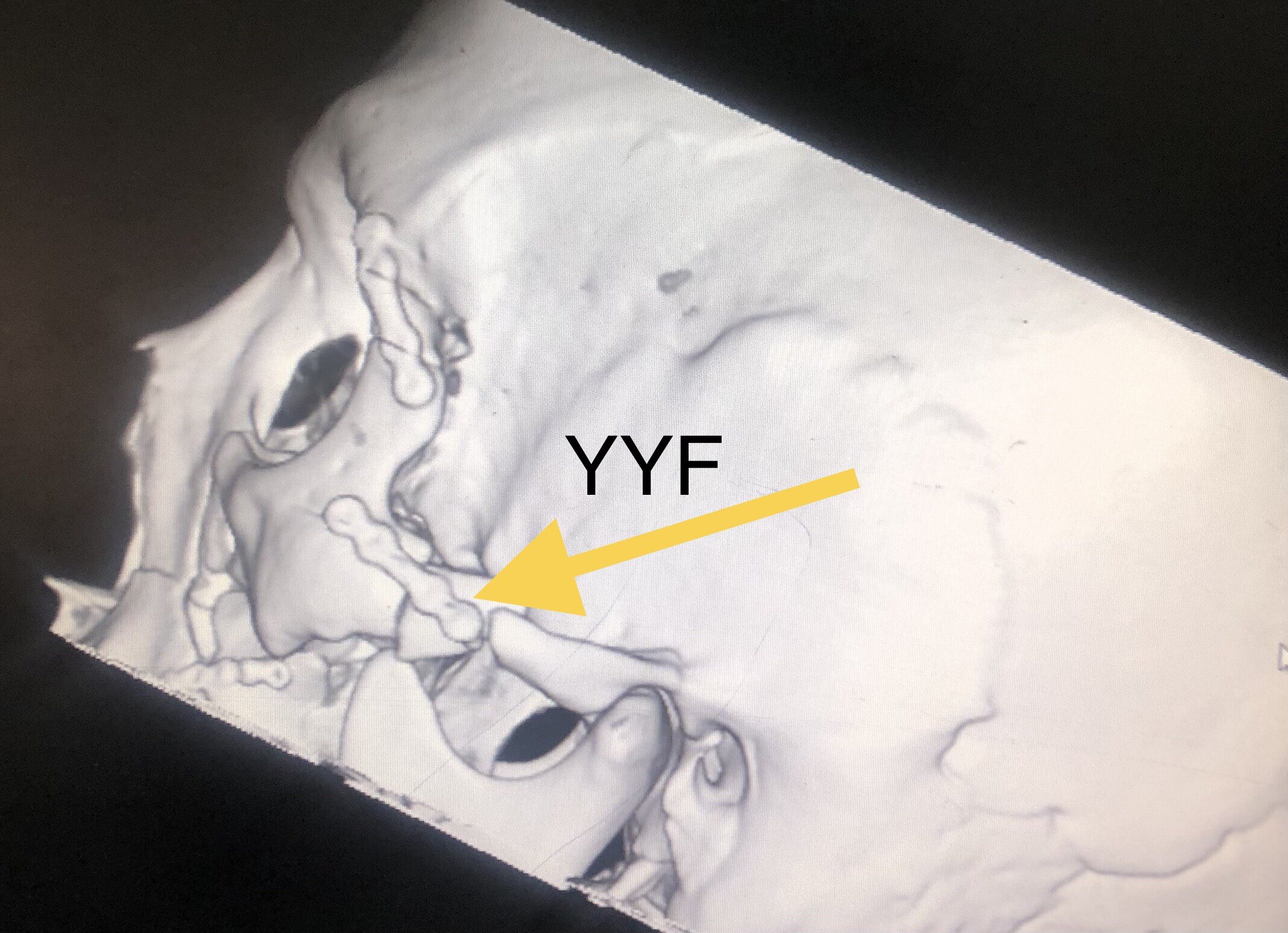 眼眶复合性骨折之颧骨,颧弓的复位固定&手术时机很重要