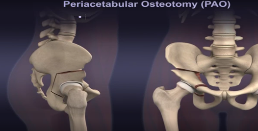 保髋有道截骨利器髋关节周围截骨术拯救严重髋关节发育不良