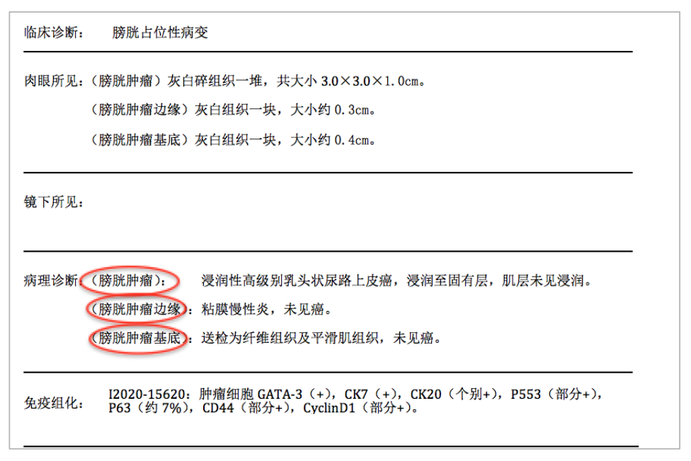 膀胱癌 病理报告图片