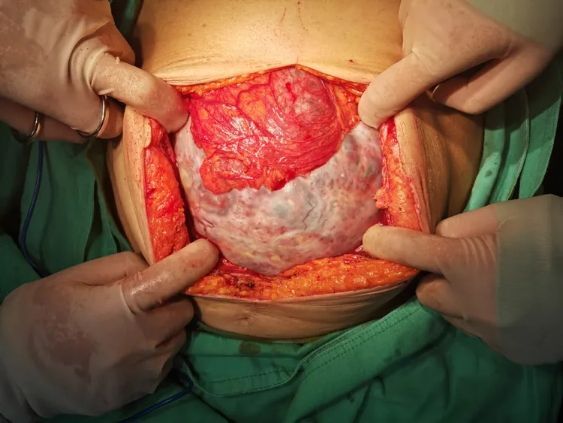 腹腔长满肿瘤照片图片