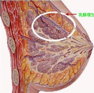 乳腺增生症前期图片