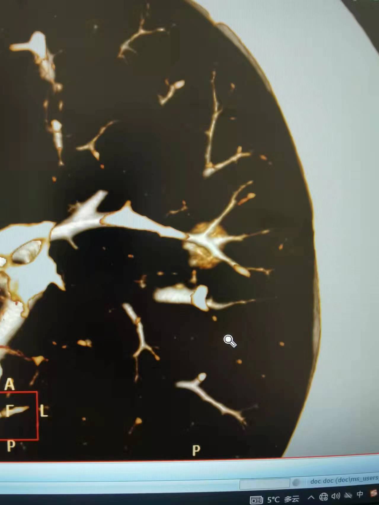 穿过肺结节的血管其实是一个纸老虎