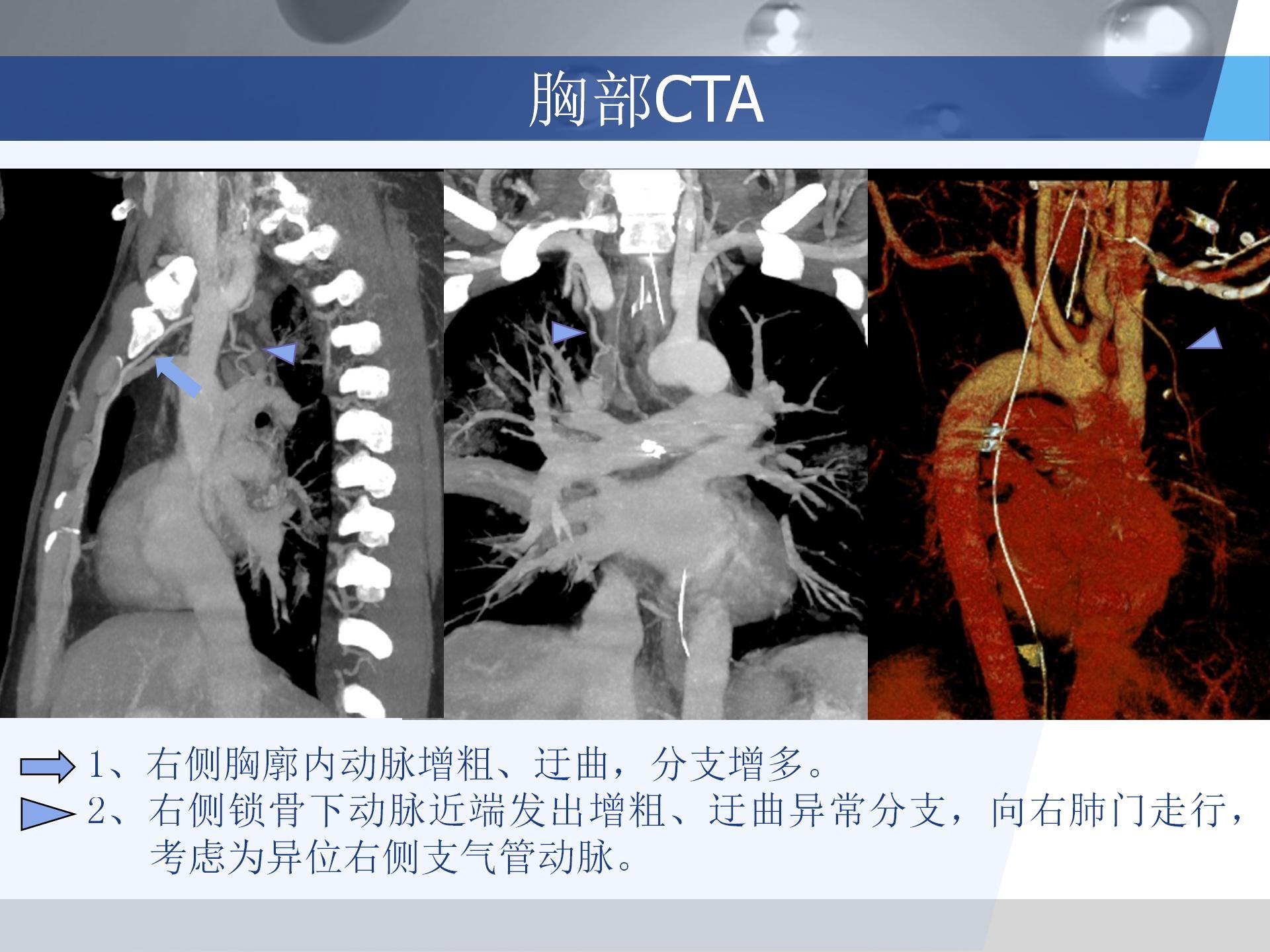 广医附一院-咯血病例汇报 [自动保存的]_05.jpg