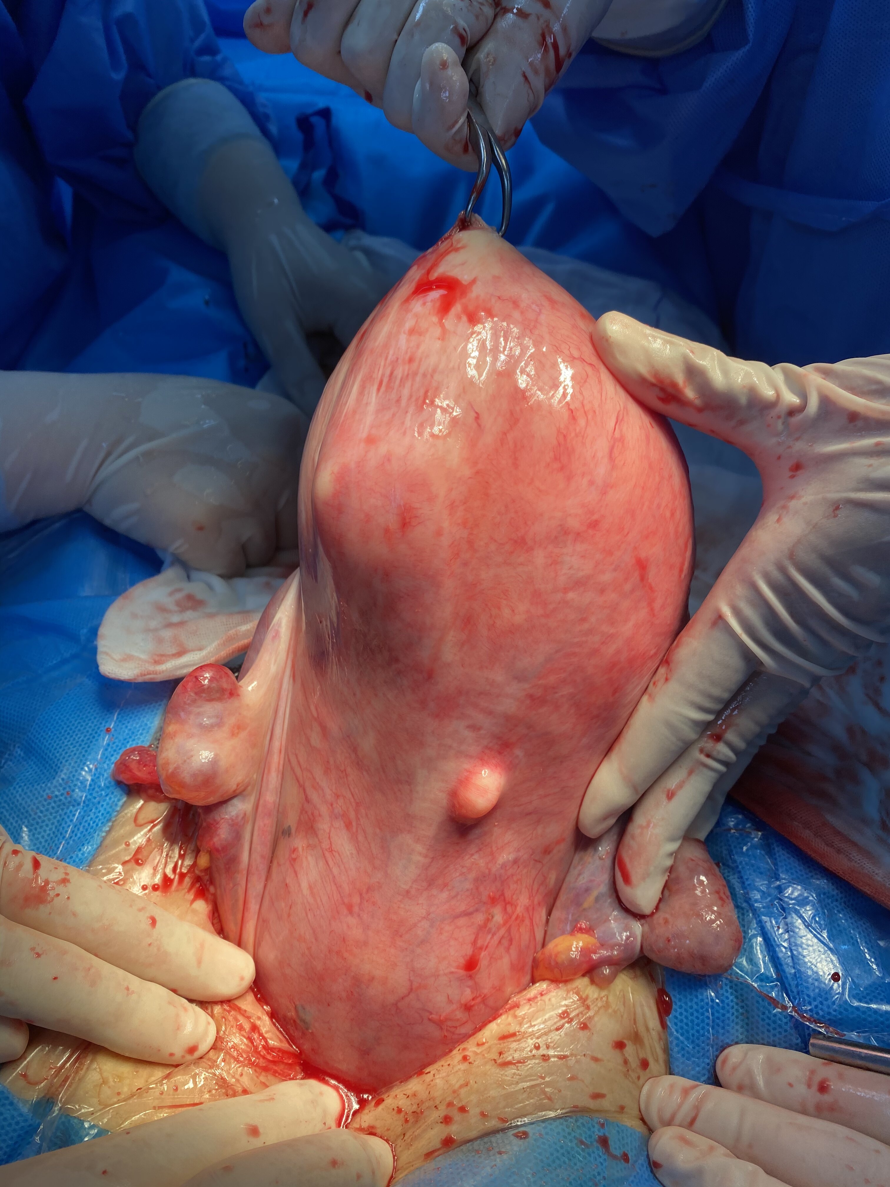 宫颈口肌瘤图片图片