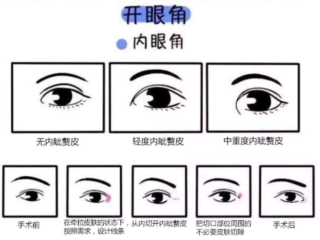 内眦赘皮是指在内眦角前方的一片垂直的皮肤褶皱,也就是蒙古褶.