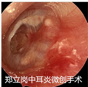 耳膜钙化图片